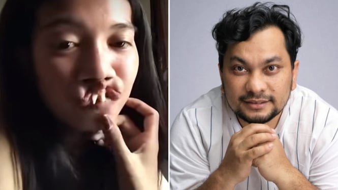 Suaranya Merdu, Tompi Puji Wanita dengan Bibir Sumbing